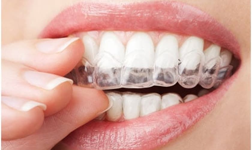 a técnica ortodôntica do “aparelho invisível” tem sido uma das principais alternativas para o alinhamento dos dentes sem atrapalhar a estética. (Foto: Reprodução/ Unidonto)