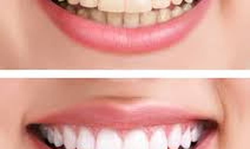 dentes amarelados