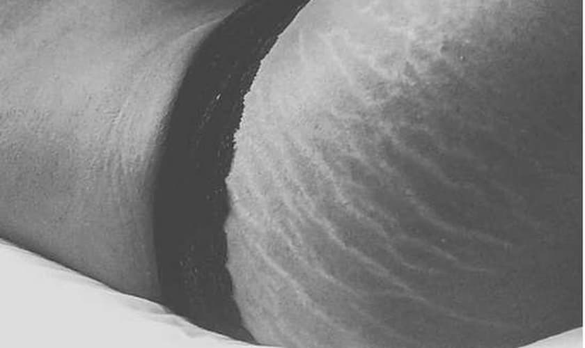 campanha contra estrias