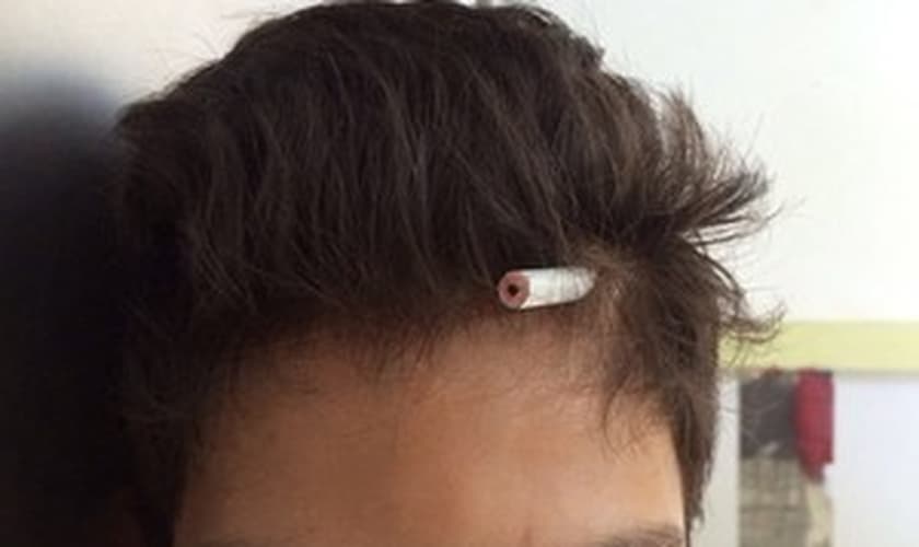 Lápis ficou cravado na cabeça de garoto