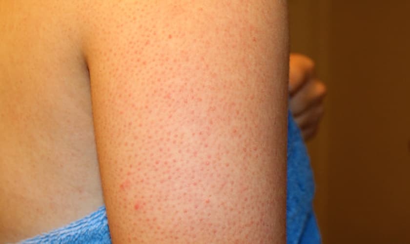 bolinhas no braço
