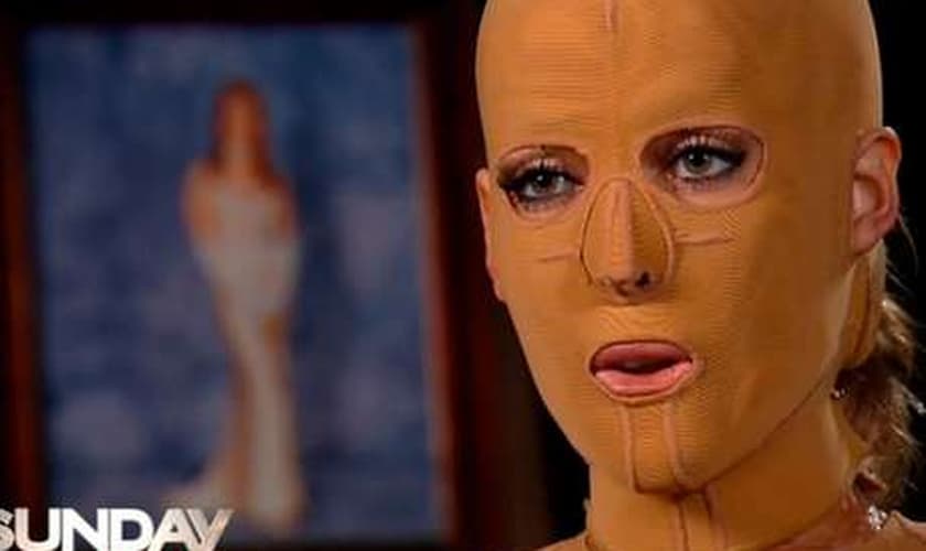 Dana foi atacada por uma mulher enciumada e teve a maior parte de seu corpo queimada