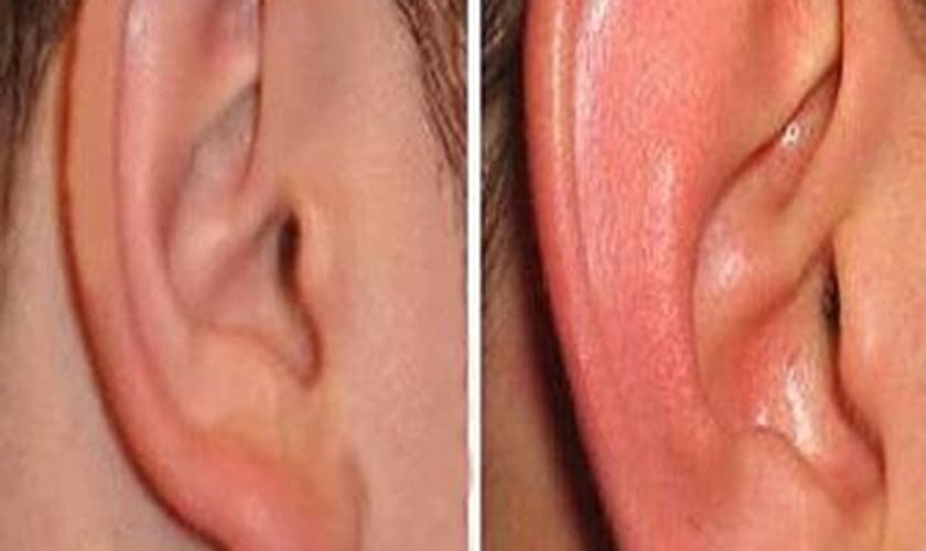 Sinal de infarto pode ser indicado pelo lóbulo da orelha