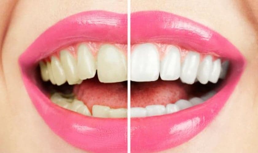 clareamento de dentes