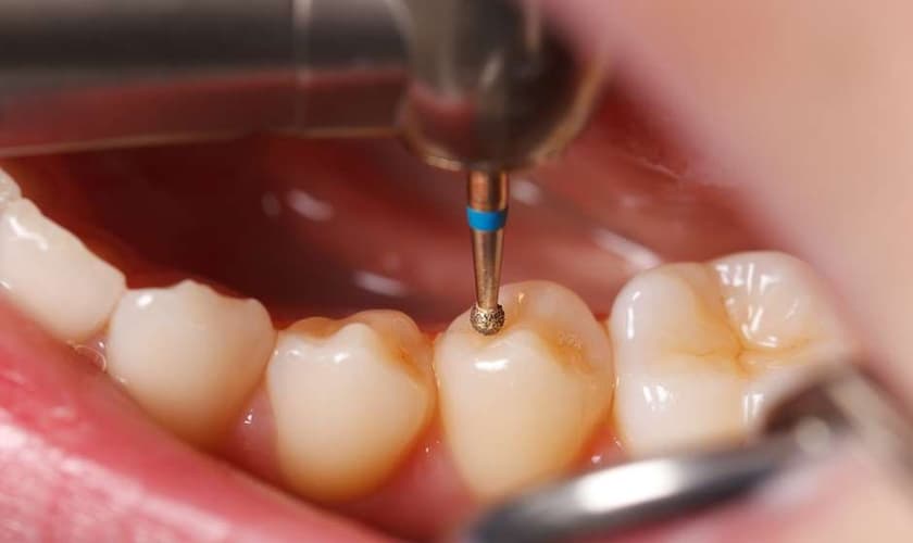 Alluminajet é um tratamento menos doloroso na remoção de cárie dental