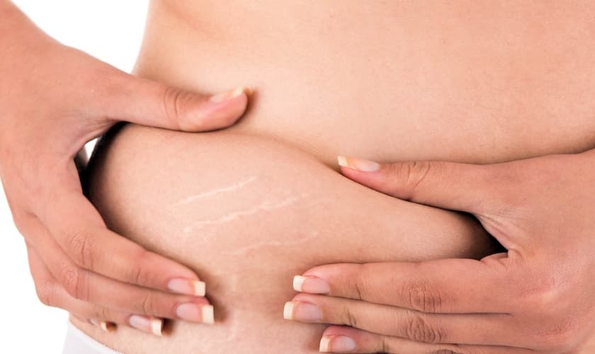 Tratamento para estrias