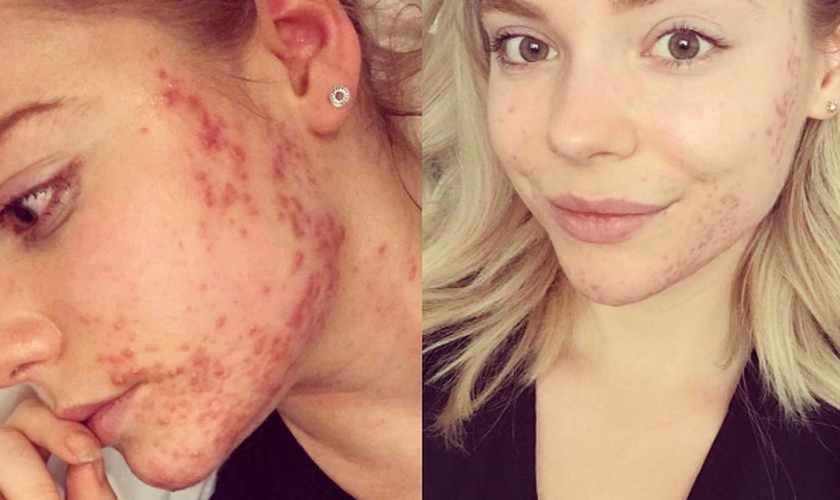 Rachel Crawley descobriu como tirar as espinhas de seu rosto com alimentação. (Foto: Reprodução/Instagram)