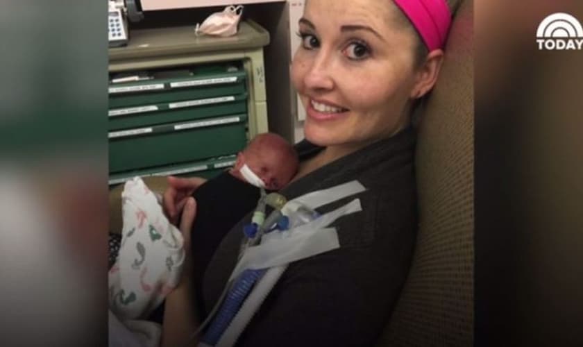A pequena Watson nasceu com apenas 25 semanas de gestação, pesando pouco mais de 300 gramas. (Foto: Today.com)
