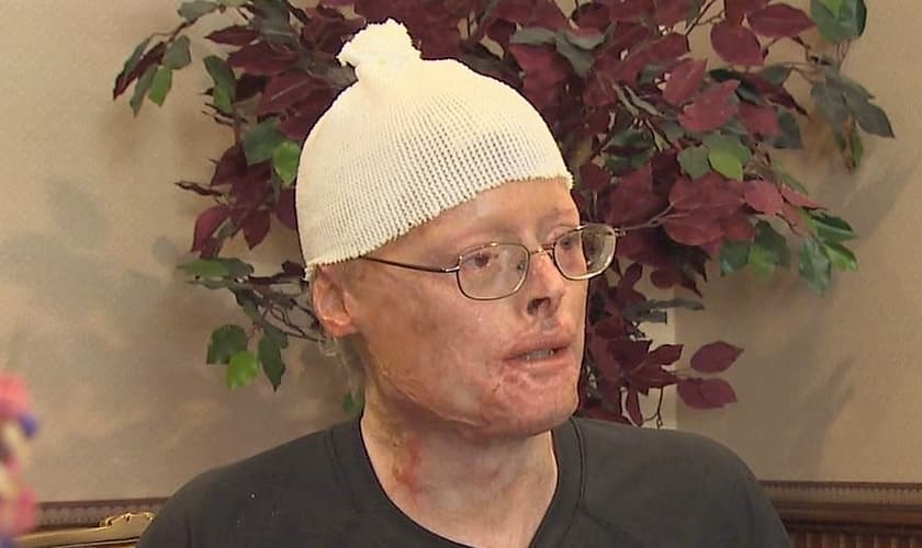 Jimmy Carter teve que passar por cerca de 20 cirurgias de reconstituição. (Foto: Facebook)