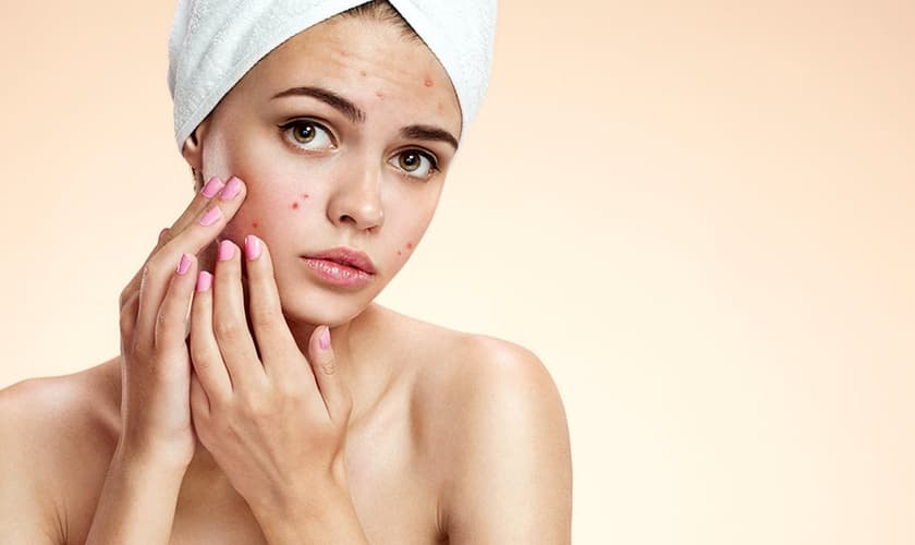 A remoção forçada da acne mais prejudica do que ajuda a pele. (Foto: Reprodução)