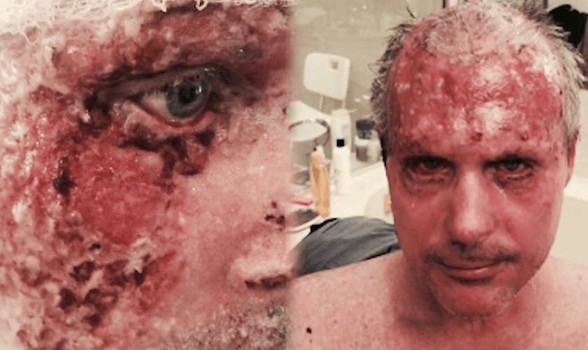 Chris ficou com mais de 20% de seu corpo com queimaduras. (Foto: Reprodução).