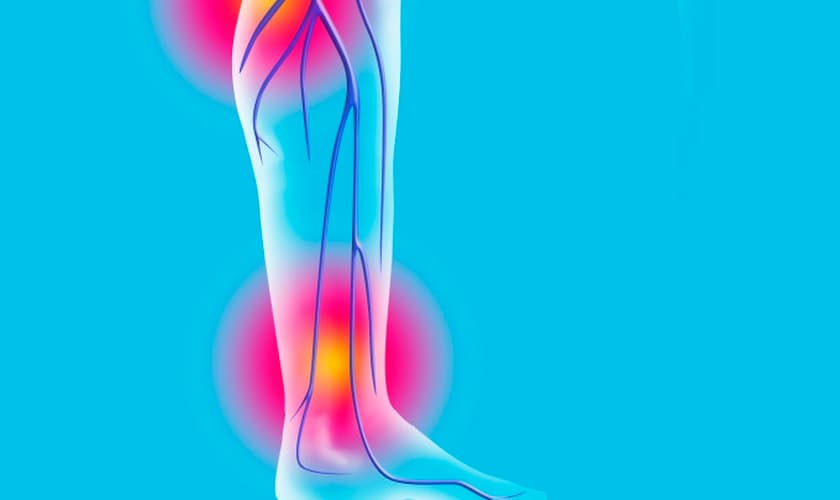 As varizes atingem principalmente as mulheres e podem causar problemas sérios à saúde. (Foto: GettyImages/BSIP)