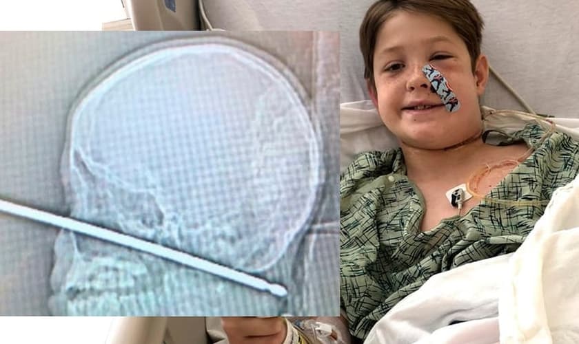 Xavier tropeçou e teve a cabeça perfurada por um espeto de carne. (Foto: Shannon Miller)