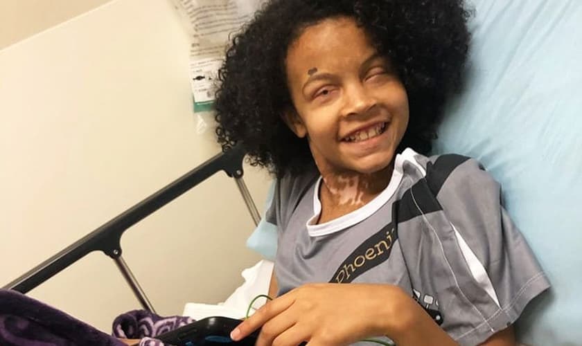 Phoenix Richey superou uma síndrome rara que afetou 65% de sua pele. (Foto: Facebook/Pray For Phoenix)
