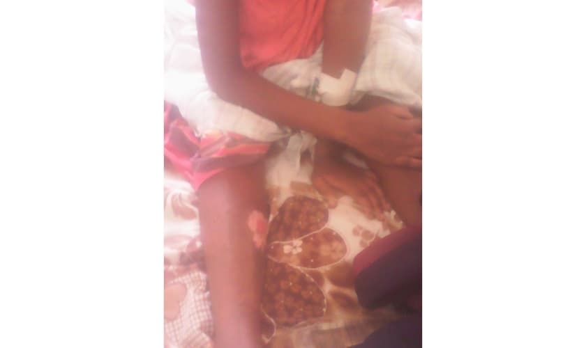 Rehema Kyomuhendo se recupera das queimaduras no Hospital de Mbale, em Uganda. (Foto: Morning Star News)
