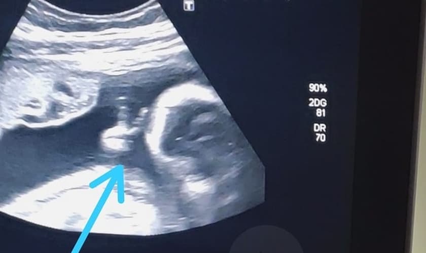 O bebê Davi fez o sinal de “V de vitória” durante o ultrassom. Foto: Arquivo pessoal/Felipe dos Santos).