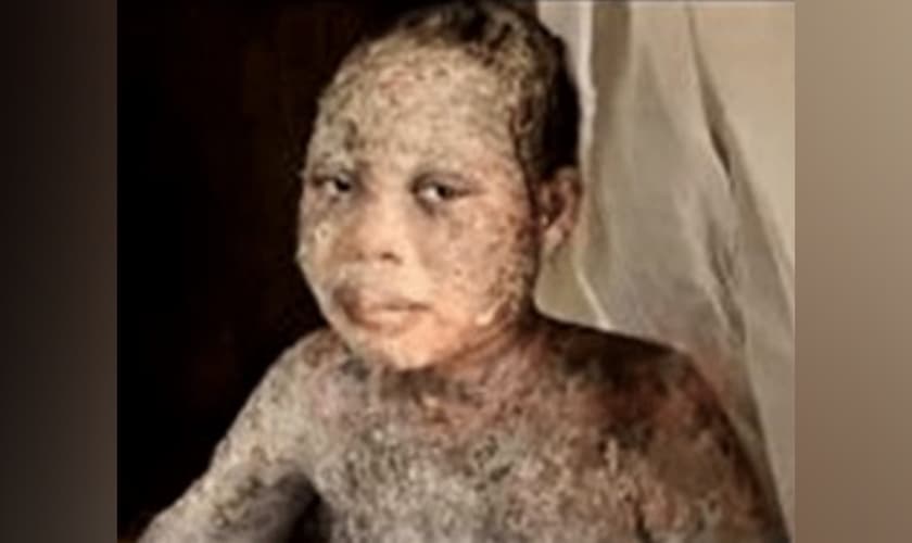 Amina Nagudi, de 13 anos, foi atacada com ácido junto com os pais, por aceitar Jesus, em Uganda. (Foto: Morning Star News).