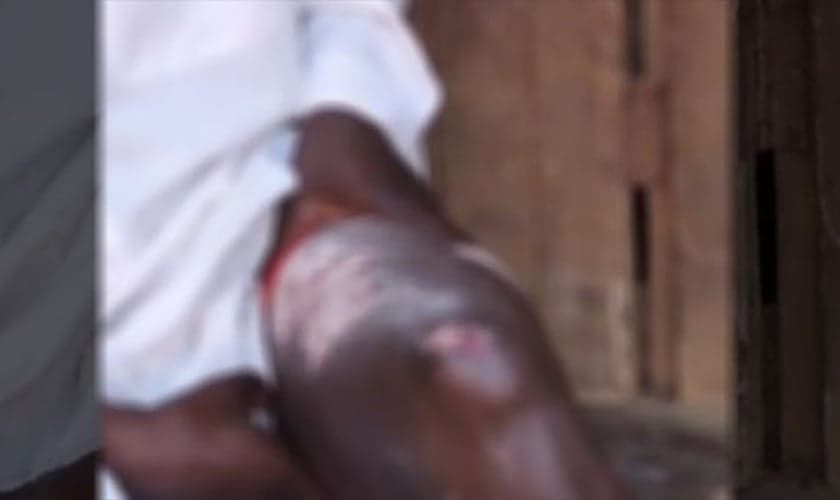 Yusufu mostra queimaduras de terceiro grau em uma das pernas. (Foto: Reprodução/Morning Star News)