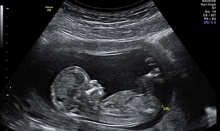 O uso de cloreto de potássio em abortos não é regulamentado no Brasil. (Foto: Wikimedia Commons/Wolfgang Moroder).