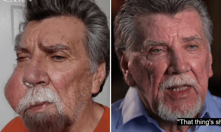 David Baker durante a doença e após sua cura. (Captura de tela/CBN News)