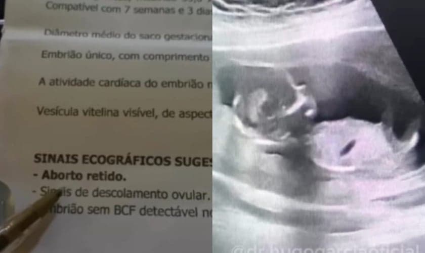 O Dr. Hugo Garcia compartilhou o testemunho, mostrando o bebê vivo no ultrassom. (Foto: Reprodução/Instagram/Dr. Hugo Garcia).