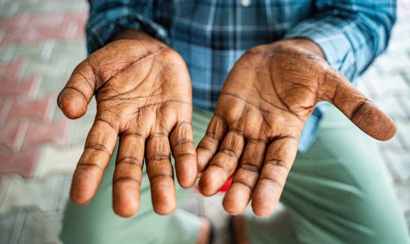 As cicatrizes de Kumar. (Foto: Reprodução/Global Christian Relief)